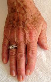 Brown Spots On Hand Before Ipl Treatment At Pampers Escape Beauty Therapy Clinic In Blenheim Marlborough NZ