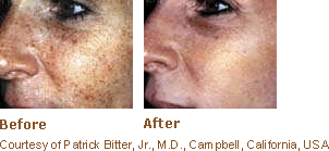 Example Of Photorejuvenation At Pampers Escape Beauty Therapy Clinic In Blenheim Marlborough NZ