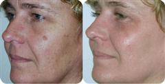 Removal Of Brown Spots Sun At Pampers Escape Beauty Therapy Clinic In Blenheim Marlborough NZ